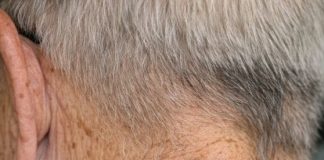 My grandpa has these dark waxy bumps on his neck that itch. What are they?