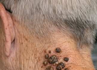 My grandpa has these dark waxy bumps on his neck that itch. What are they?