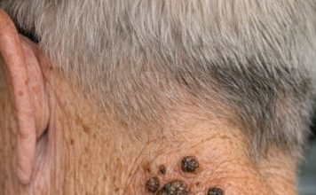 My grandpa has these dark waxy bumps on his neck that itch. What are they?
