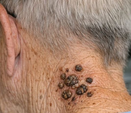 My grandpa has these dark waxy bumps on his neck that itch. What are they?