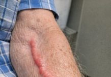 My grandfather woke up with this swollen red cord like vein on his arm. It is tender and warm but the urgent care is closed until tomorrow. Should we go to the ER?