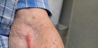 My grandfather woke up with this swollen red cord like vein on his arm. It is tender and warm but the urgent care is closed until tomorrow. Should we go to the ER?