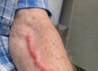 My grandfather woke up with this swollen red cord like vein on his arm. It is tender and warm but the urgent care is closed until tomorrow. Should we go to the ER?