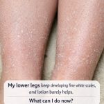 My lower legs keep developing fine white scales, and lotion barely helps. What can I do now?