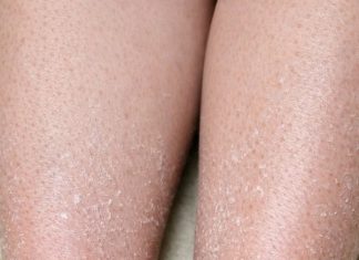 My lower legs keep developing fine white scales, and lotion barely helps. What can I do now?