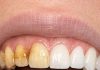 Swish this 1 mixture in your mouth and get rid of coffee stains, tea discoloration, and dull enamel