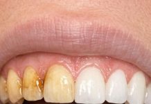 Swish this 1 mixture in your mouth and get rid of coffee stains, tea discoloration, and dull enamel