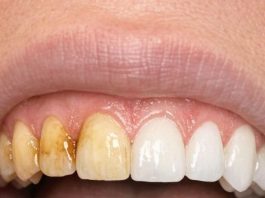 Swish this 1 mixture in your mouth and get rid of coffee stains, tea discoloration, and dull enamel