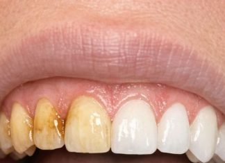 Swish this 1 mixture in your mouth and get rid of coffee stains, tea discoloration, and dull enamel