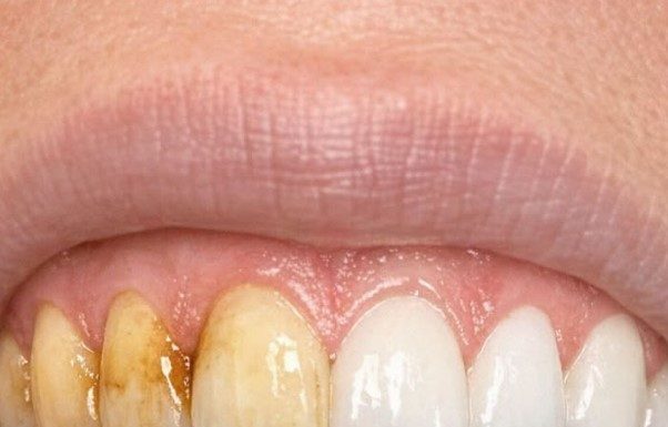 Swish this 1 mixture in your mouth and get rid of coffee stains, tea discoloration, and dull enamel