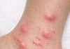 Apply this 1 mixture on your ankles and get rid of swollen mosquito welts, red bite marks, relentless itching