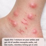 Apply this 1 mixture on your ankles and get rid of swollen mosquito welts, red bite marks, relentless itching