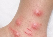Apply this 1 mixture on your ankles and get rid of swollen mosquito welts, red bite marks, relentless itching