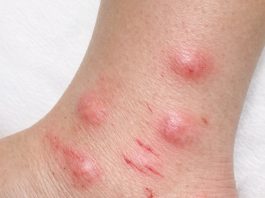 Apply this 1 mixture on your ankles and get rid of swollen mosquito welts, red bite marks, relentless itching