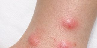 Apply this 1 mixture on your ankles and get rid of swollen mosquito welts, red bite marks, relentless itching