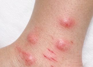 Apply this 1 mixture on your ankles and get rid of swollen mosquito welts, red bite marks, relentless itching