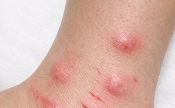 Apply this 1 mixture on your ankles and get rid of swollen mosquito welts, red bite marks, relentless itching