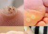 6 Types of Warts (Signs, Symptoms, Home Remedies, and Treatment)