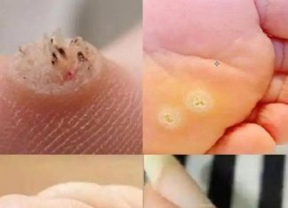 6 Types of Warts (Signs, Symptoms, Home Remedies, and Treatment)