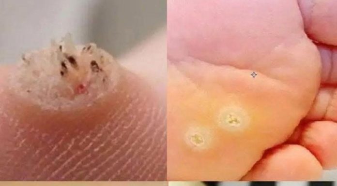 6 Types of Warts (Signs, Symptoms, Home Remedies, and Treatment)