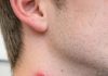 Found these red bites in a straight line on my brother’s neck this morning. He’s freaking out. Does anyone know what bit him so we can treat it?
