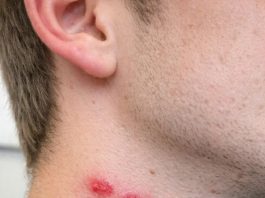 Found these red bites in a straight line on my brother’s neck this morning. He’s freaking out. Does anyone know what bit him so we can treat it?