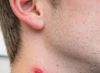 Found these red bites in a straight line on my brother’s neck this morning. He’s freaking out. Does anyone know what bit him so we can treat it?
