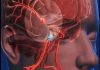 12 Early Warning Signs of an Aneurysm You Shouldn’t Ignore