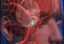 12 Early Warning Signs of an Aneurysm You Shouldn’t Ignore