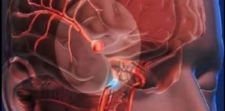 12 Early Warning Signs of an Aneurysm You Shouldn’t Ignore