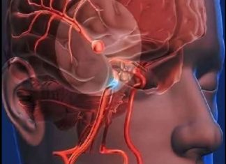 12 Early Warning Signs of an Aneurysm You Shouldn’t Ignore