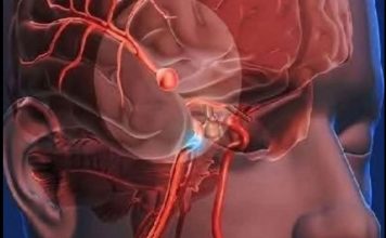 12 Early Warning Signs of an Aneurysm You Shouldn’t Ignore