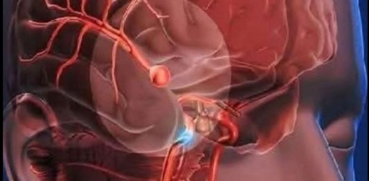 12 Early Warning Signs of an Aneurysm You Shouldn’t Ignore