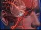12 Early Warning Signs of an Aneurysm You Shouldn’t Ignore