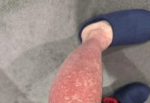 Here Are the Consequences of Sleeping with Wet Socks