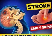 8 Warning Signs of Stroke That May Appear One Month Before — and 9 Ways to Help Reduce Your Risk