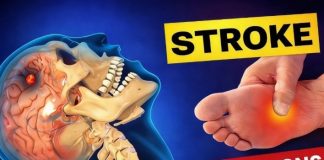 8 Warning Signs of Stroke That May Appear One Month Before — and 9 Ways to Help Reduce Your Risk