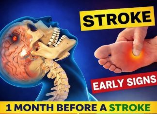 8 Warning Signs of Stroke That May Appear One Month Before — and 9 Ways to Help Reduce Your Risk