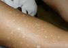 Have You Noticed Small White Spots on Your Arms or Legs? Here’s What They Are