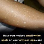Have You Noticed Small White Spots on Your Arms or Legs? Here’s What They Are