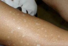 Have You Noticed Small White Spots on Your Arms or Legs? Here’s What They Are