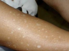 Have You Noticed Small White Spots on Your Arms or Legs? Here’s What They Are