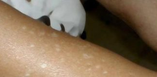 Have You Noticed Small White Spots on Your Arms or Legs? Here’s What They Are