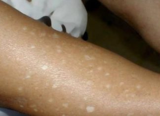 Have You Noticed Small White Spots on Your Arms or Legs? Here’s What They Are