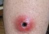 My husband woke up with this swollen red sore with a dark sunken center on his calf. We are hours from urgent care right now. Is this serious?