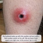 My husband woke up with this swollen red sore with a dark sunken center on his calf. We are hours from urgent care right now. Is this serious?