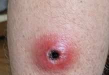 My husband woke up with this swollen red sore with a dark sunken center on his calf. We are hours from urgent care right now. Is this serious?