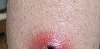 My husband woke up with this swollen red sore with a dark sunken center on his calf. We are hours from urgent care right now. Is this serious?