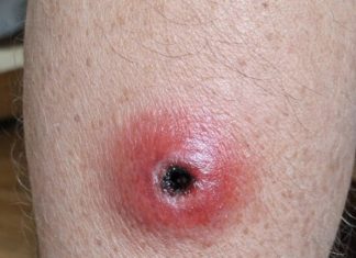 My husband woke up with this swollen red sore with a dark sunken center on his calf. We are hours from urgent care right now. Is this serious?