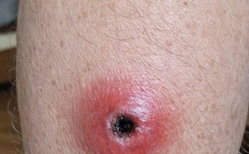 My husband woke up with this swollen red sore with a dark sunken center on his calf. We are hours from urgent care right now. Is this serious?